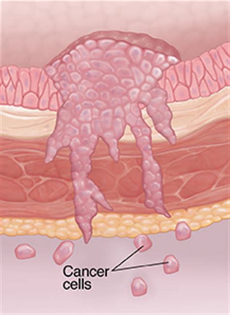 Learn more about how bladder cancer is treated. Staging of Bladder Cancer