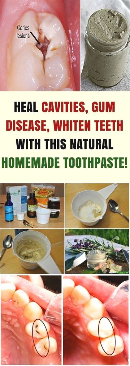 heal cavities gum disease whiten teeth use this natural homemade toothpaste health