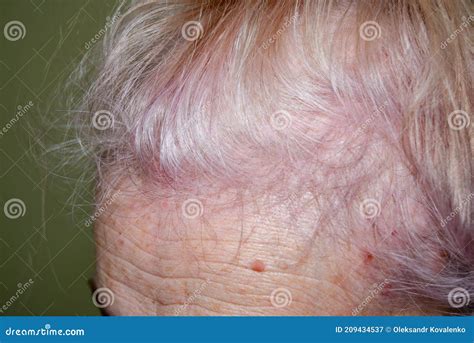 Alopecia In Patient With System Lupus Erythematosus Diffuse Hair Loss
