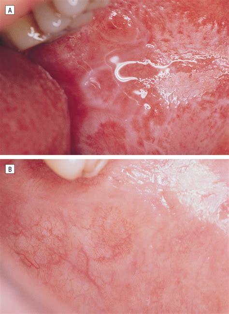 Effective Treatment Of Oral Erosive Lichen Planus With Thalidomide