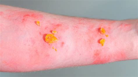 Images Of Poison Ivy On Skin