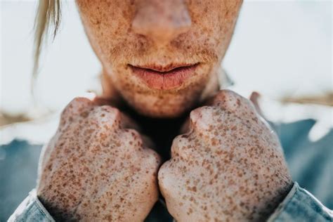 8 Things You Never Knew About Freckles
