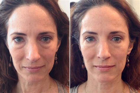 Does Massaging Face Reduce Wrinkles Facial Adviser
