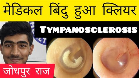 कान का मेडिकल बिंदु हुआ क्लियर 👂 Tympanosclerosis 👂 Ashokbest Jaipur