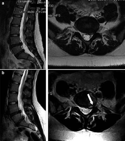Comparison Between Sagittal And Axial Mri Projections Obtained In