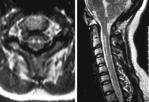 Symmetrical Infarction Of The Cervical Spinal Cord Due To Spontaneous