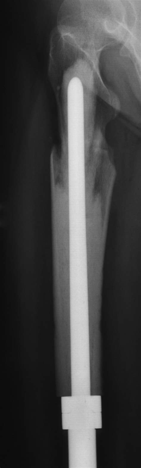 Cortical Strut Bone Grafting And Long Stem Endoprosthetic