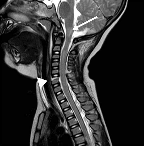 Progressive Cervical Spinal Cord Atrophy After A Traffic Accident The