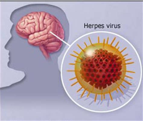 La encefalomielitis aguda diseminada es la inflamación del cerebro y la médula espinal producida por una reacción de hipersensibilidad a un virus o a una proteína extraña. Encefalitis - Información médica en Ferato, enciclopedia ...