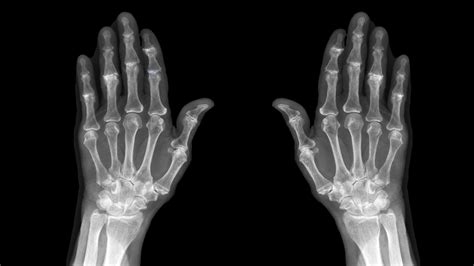 Osteoarthritis Radiology Hand X Ray Stock Képek és Fotók Rf