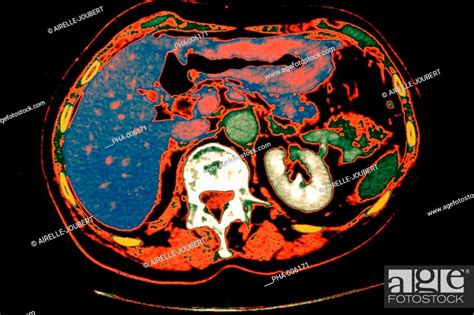 Coloured Axial Computed Tomography Ct Scan Of The Abdomen Showing A