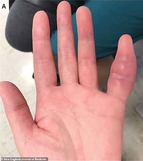 Swollen Pinky Finger Was A Rare Sign Of Deadly Tuberculosis For