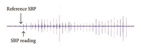 Waveform Examples Of Korotkoff Sounds To Illustrate The Uncertainties