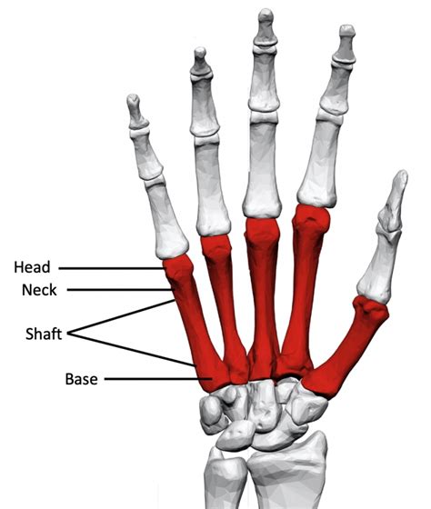 Metacarpal Fractures Fife Virtual Hand Clinic