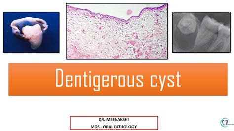 Dentigerous Cyst Youtube