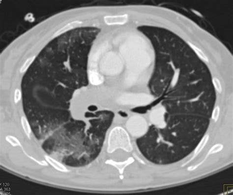 large pulmonary embolism  lung infarct  splenic infarct chest case studies ctisus ct