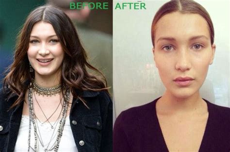 Before and after see more ». Bella Hadid Plastic Surgery Before and After | Rosto ...