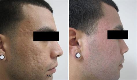 Know Cemsim Ice Pick Scars Before And After Treatment