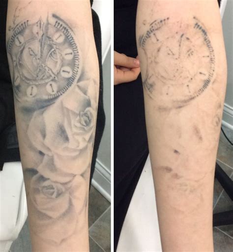 Laser Tattoo Removal Before After Bare Tattoo And Hair Removal