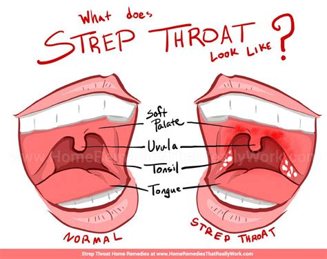 Sore Throat Enlarged Neck Lymph Nodes Swollen Tonsils Tender Lymph
