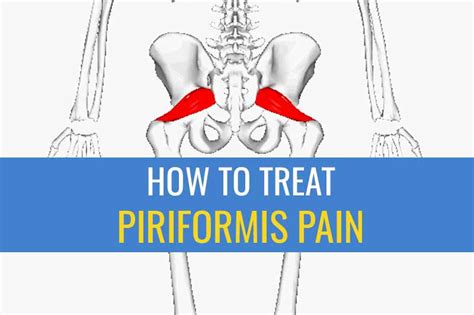 5 Tips For Treating Piriformis Pain Sports Injury Physio