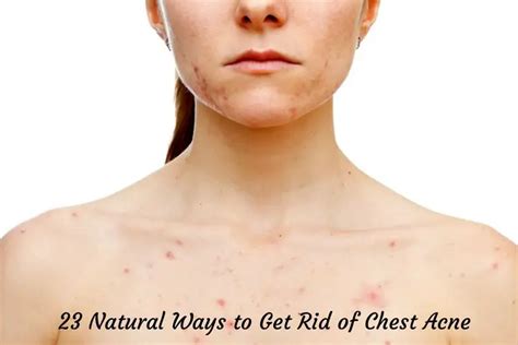 23 Natural Ways To Get Rid Of Chest Acne