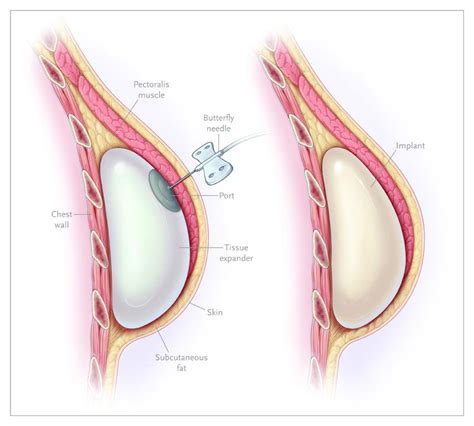 Breast Reconstruction After Surgery For Breast Cancer Nejm