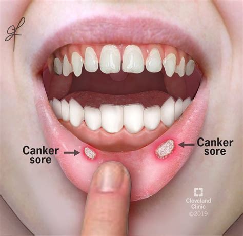 Photograph Canker Sore Aphthous Stomatitis Science Source Images The