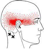 Dry Needling Masterclass Occipital Neuralgia Rory McKay The Health
