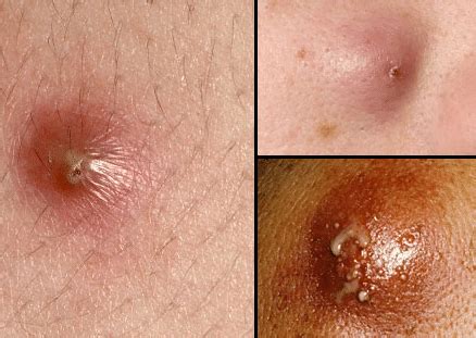 What are boils and carbuncles? Boils on Inner Thigh Causes, No Head, Painful, Recurring ...