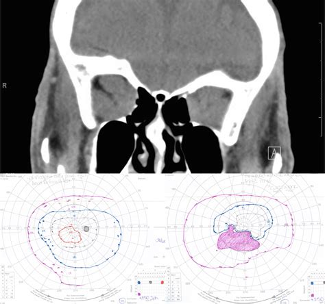 Thyroid Eye Disease Presenting Symptoms