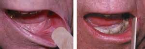 Photos Of Oral Cancer On Floor Of Mouth