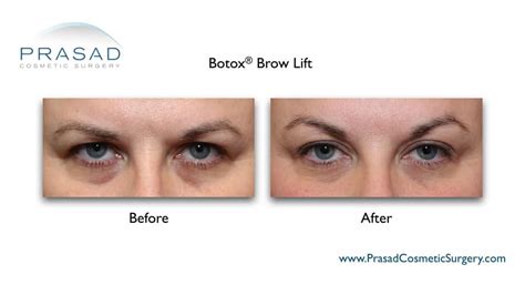 Brow Lift Before And After Photos Manhattan And Long Island Ny