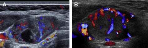 Ultrasonography Of Cervical Lymph Nodes Radiologic Clinics