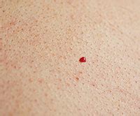 Angioma or haemangioma (american spelling 'hemangioma') describes a benign vascular skin lesion.an angioma is due to proliferating endothelial cells; Adult & Pediatric Dermatology - Galaria MD
