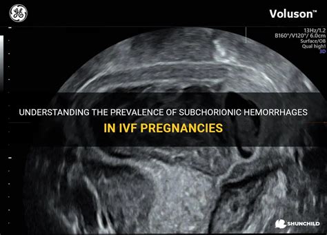 Understanding The Prevalence Of Subchorionic Hemorrhages In Ivf