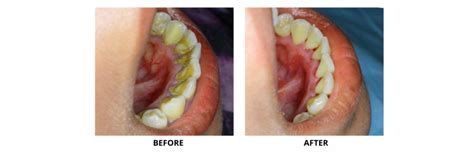Oral Prophylaxis Success Dental Clinic
