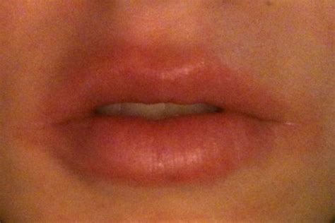Rash Around Lips Angular Chelitis Beeswax Allergy Please Help I Am