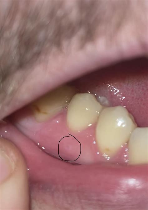 Painless Small Bump On Gums Should I Be Concerned Raskdentists