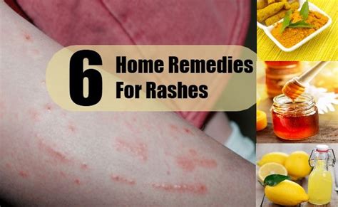 Home Remedies For Rashes Home Remedies Essential Oil Treatments