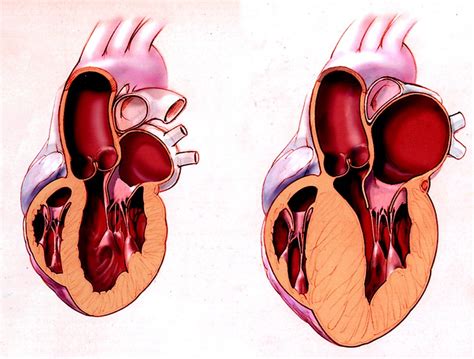 6 Causes Of Enlarged Heart Trainer