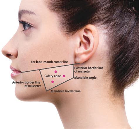 Figure 1 From Botulinum Toxin Type A For Treatment Of Masseter