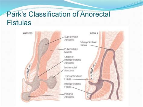 Anorectal Fistula