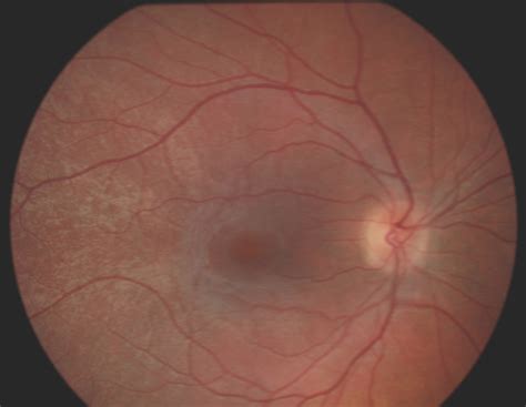Fundus Photography Demonstrating A Tapetal Like Reflex In A 22 Year Old