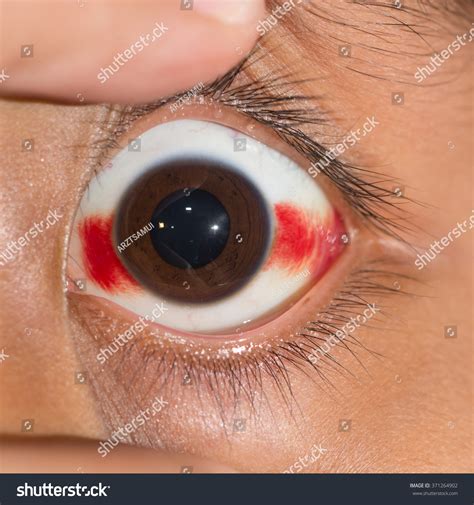 Close Up Of The Sub Conjunctival Hemorrhage During Eye Examination