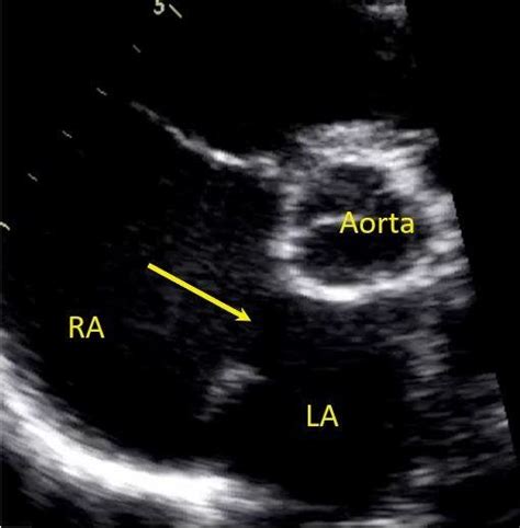 Still Image From A Trans Thoracic Echocardiogram In Parasternal