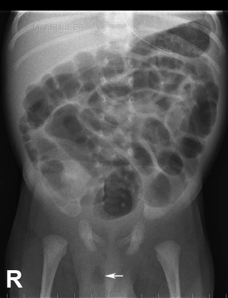 Neonatal Abdominal Radiography Wikiradiography