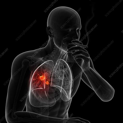 According to the centers for disease control and prevention, you can reduce your risk of lung cancer if you: Lung cancer due to smoking, artwork - Stock Image - F007 ...
