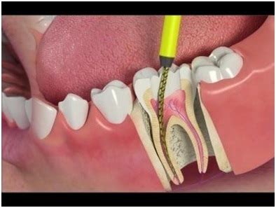 | does your tooth need root canal? How to Tell if You Need A Root Canal