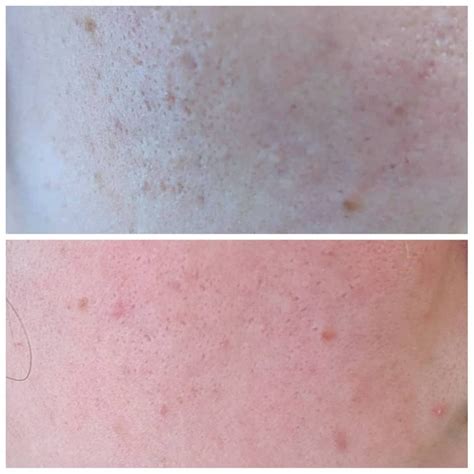 Derma Rolling Before And After Rejuviss